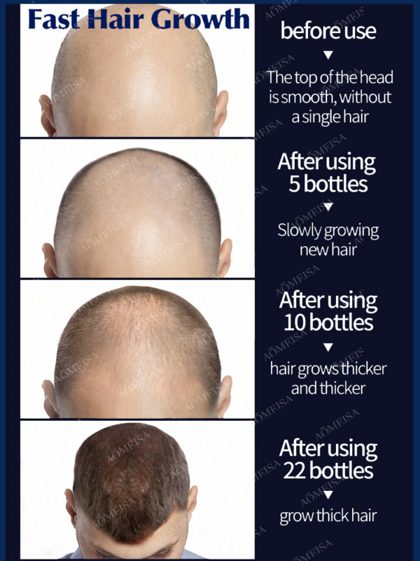 Rapid hair growth essential oil, repair baldness