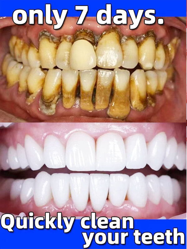 Dentifrice blanchissant au fluorure pour les dents, calcul dentaire, élimination des odeurs buccales, prévention temporaire de la parodontite