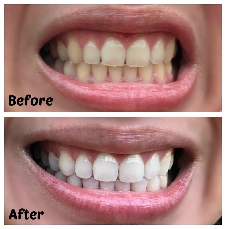 Extrato de ervas orgânicas para clareamento dental, clareamento dental, higiene oral saudável, limpeza da boca, limpar a placa removedora de manchas