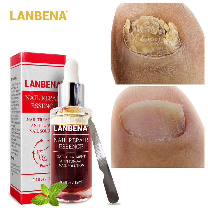 LANBENA Fungal Nail Repair Essence Serum Treatment Care Foot Nail Fungus Removal Gel Anti Infection Paronychia Onychomycosis