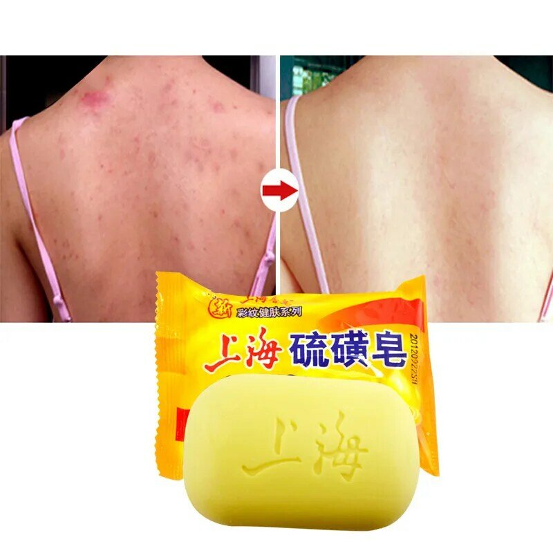 Psoríase seborrhea eczema anti banho de fungo sabão saudável tratamento de acne do óleo-controle do sabão do enxofre de shanghai removedor de cravo