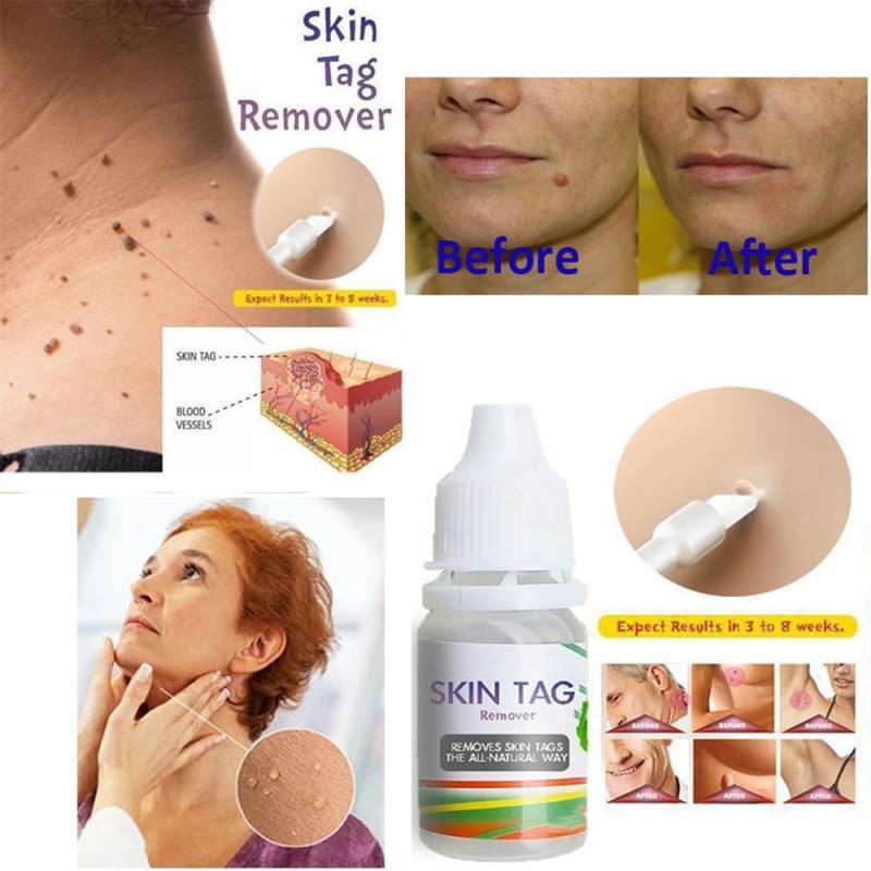 10ml Skin Tag Remover Skin Tags Genital Wart Remover Foot Care Cream Treatment Foot Corn Removal Blackhead Remover Liquid TSLM1