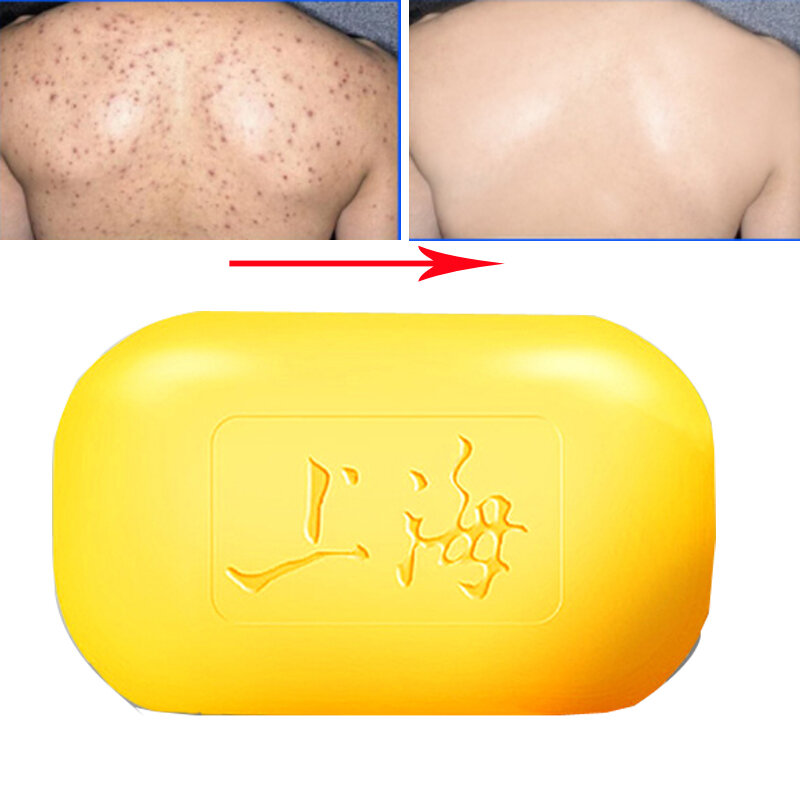 10 pçs shanghai sabão de enxofre acne psoríase 4 condições da pele seborrhea eczema anti fungo perfume manteiga bolha banho 85g