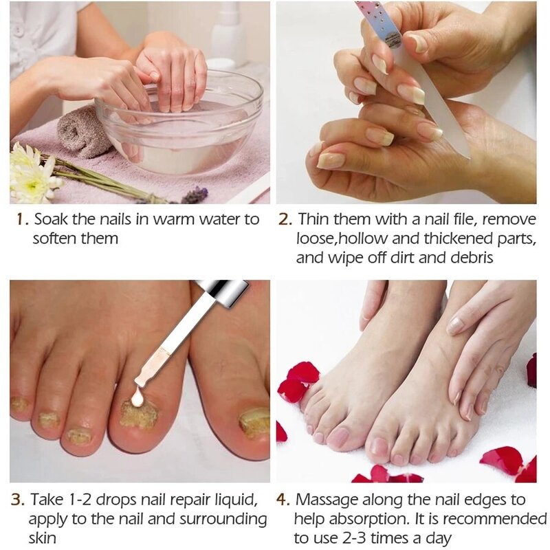 Tratamiento de hongos para uñas, esencia para el cuidado de los pies, eliminación de hongos de las uñas de los pies, Gel antiinfección, paroniquia, onicomicosis, 20ML