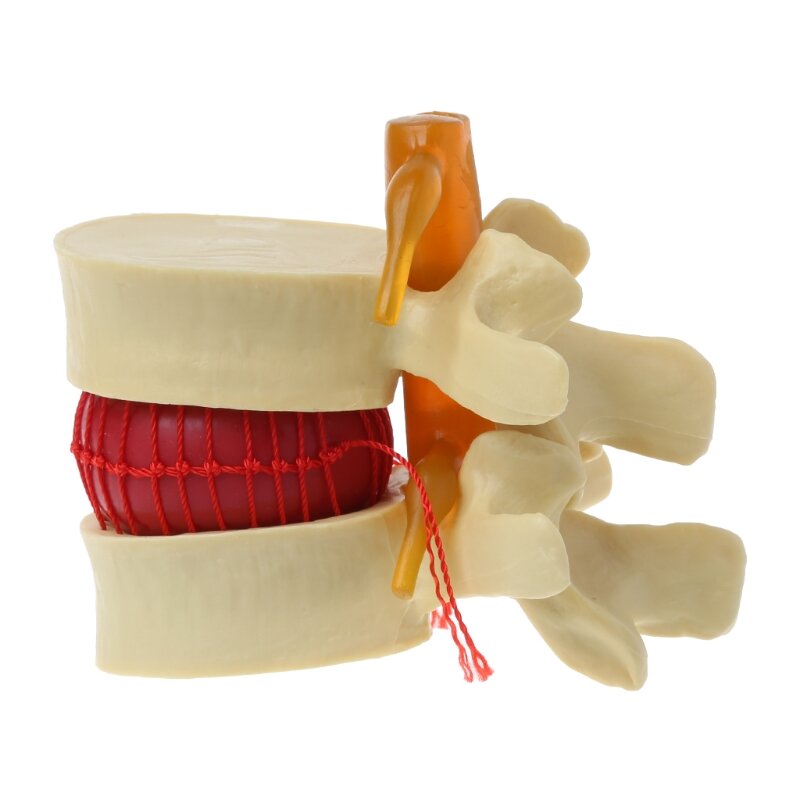 Outil d'enseignement médical d'anatomie de hernie discale lombaire de colonne vertébrale anatomique