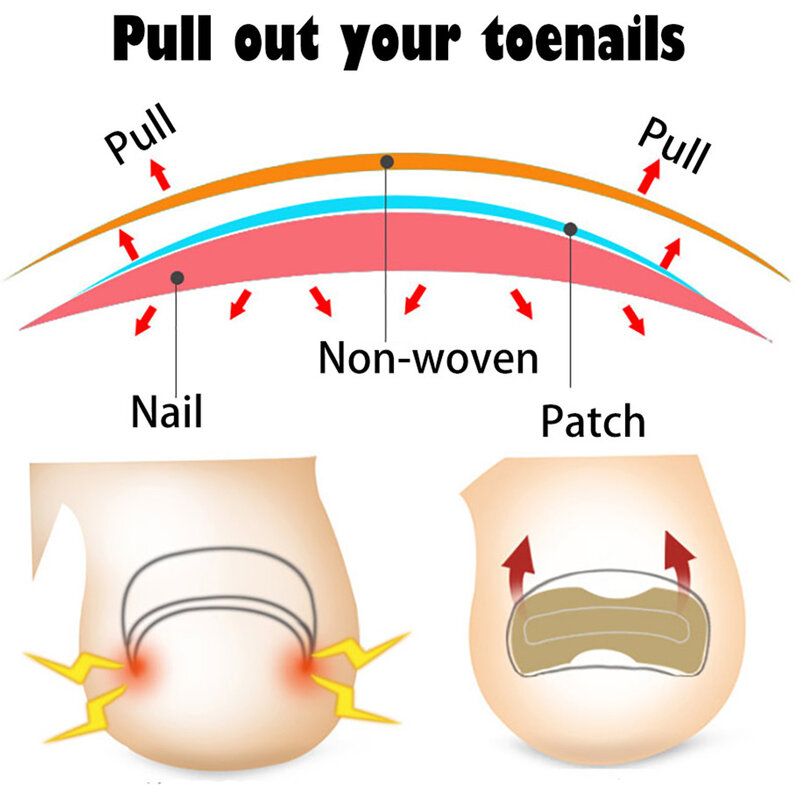 20/50/100 pces correção do prego adesivos encravados toenail corrector remendos paronychia tratamento recuperar corretor pedicure ferramentas
