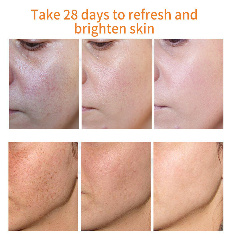 Freckle Cream Remove Dark Spots Whitening Cream Fade Acne Scars Brighten Melanin Pigmentation Melasma Anti-Aging Whiten Skin 20g