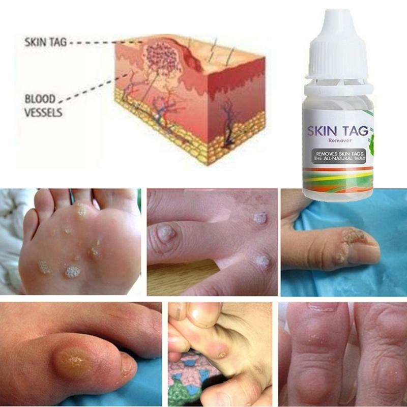 Removedor de marcas na pele, removedor de marcas na pele, tratamento para cuidados com os pés, removedor de cravos no líquido tslm1 com 10ml