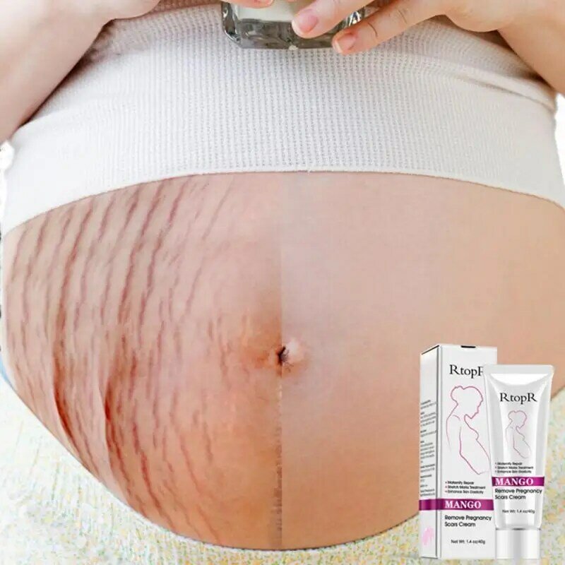 New Concealer Mango Remove Pregnancy Acne Scar Stretch Mark Cream Treatment Maternal Anti-Aging Repair Anti-Wrinkle Firming Body