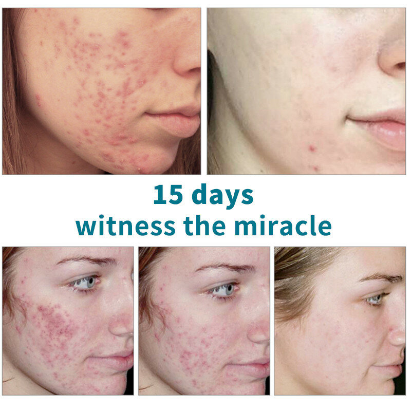AUQUEST-crema facial con ácido salicílico para el cuidado de la piel, Gel antiacné que reduce los poros, suero hidratante, elimina los puntos negros, 15ML