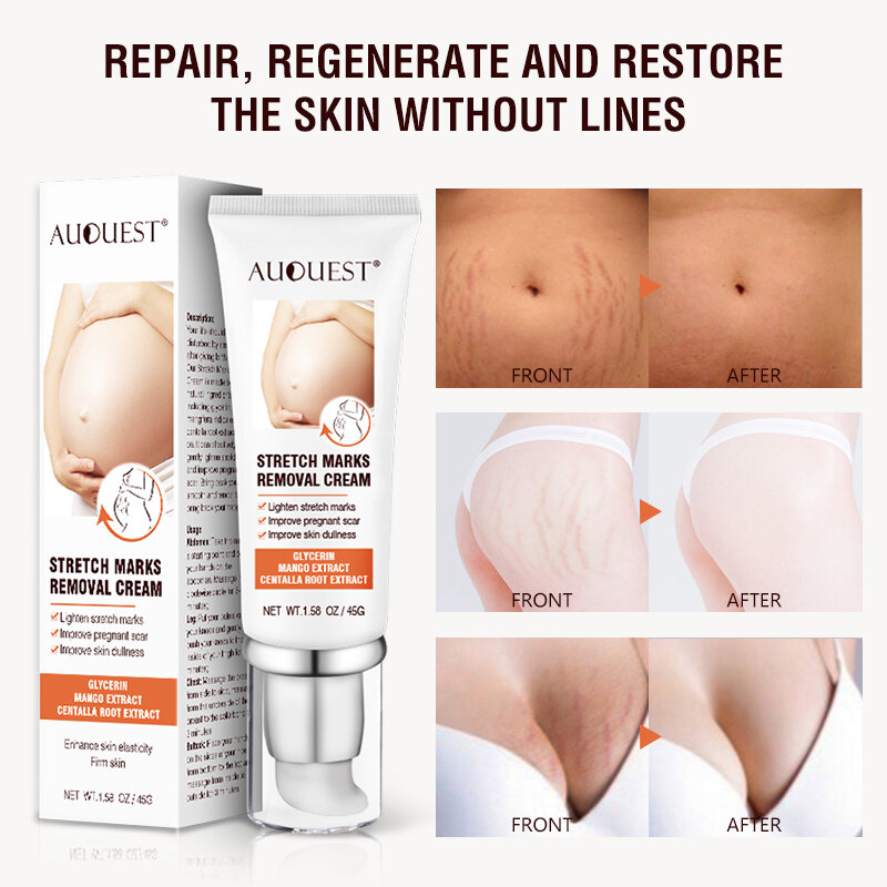 Auquest Striae Remover Body Cream Huidverzorging Moederschap Cream Voor Stretch Mark Behandeling Verwijdering Zwangere Verstevigende Huidverzorging