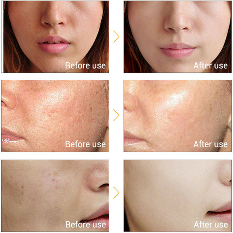 Vitamina c puro 100% forte ácido hialurónico anti envelhecimento rugas pele que aperta o soro facial nutre o creme facial da cara da pele 30ml