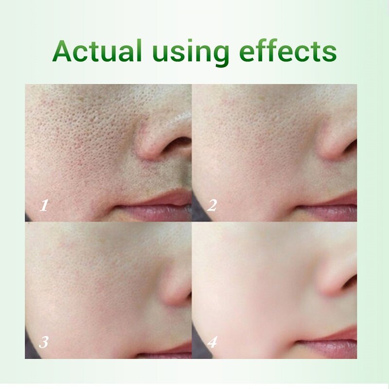 10 pces poros de ácido salicylic refino creme retrátil poros melhorar acnes cravos clareamento creme anti-envelhecimento controle de óleo cuidados com a pele