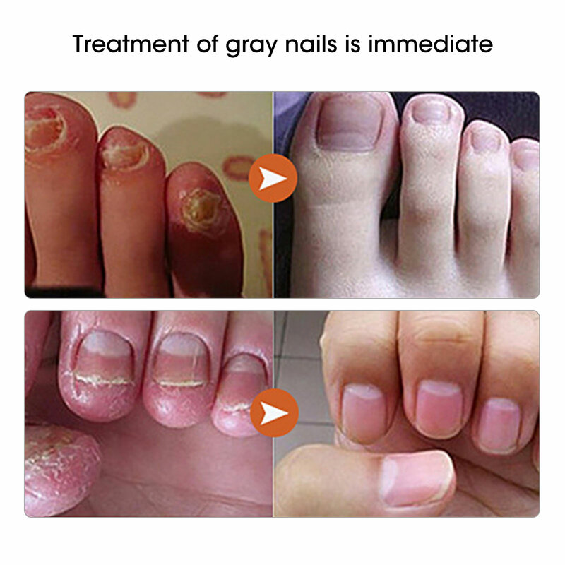 เล็บเชื้อรา Treatment Feet Care Essence เล็บฟอกสีฟันเล็บเท้ากำจัดเจล Anti Infection Paronychia Onychomycosis