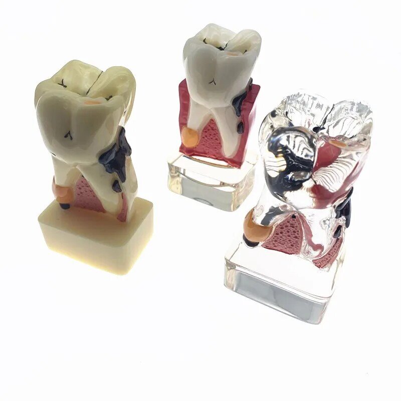 O estudo dental ensina o modelo da doença dos dentes do modelo do dente para o ensino dental