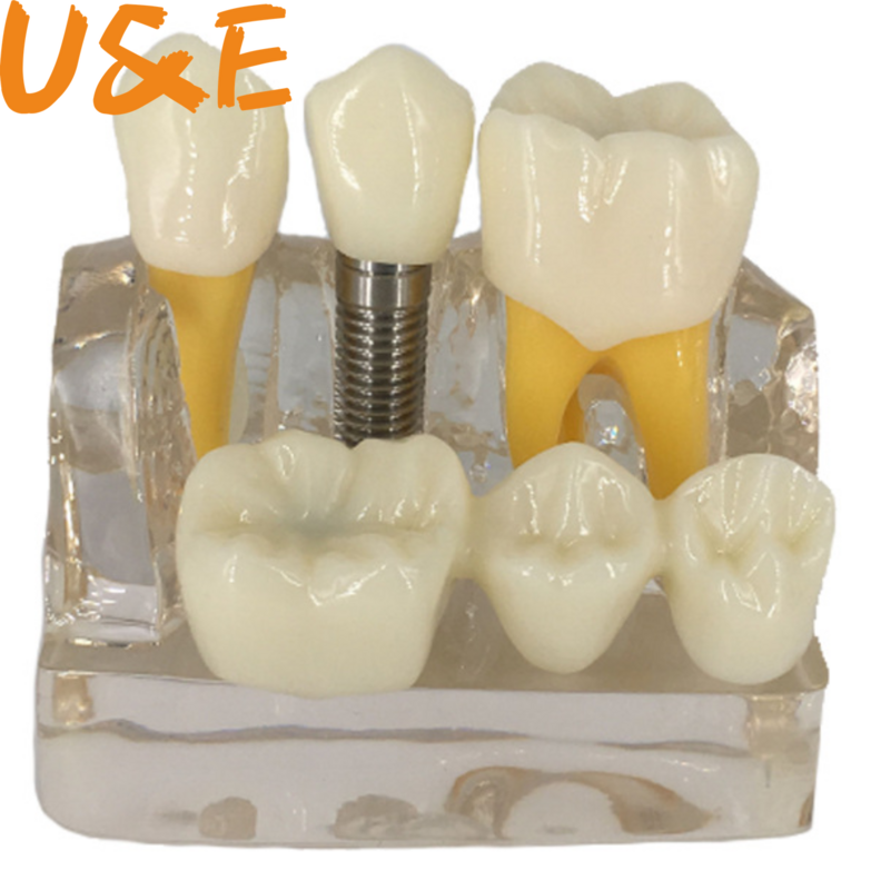 Модель зубов, прозрачная модель зубного имплантата, стоматологический зуб, обучение, обучение, общение исследований