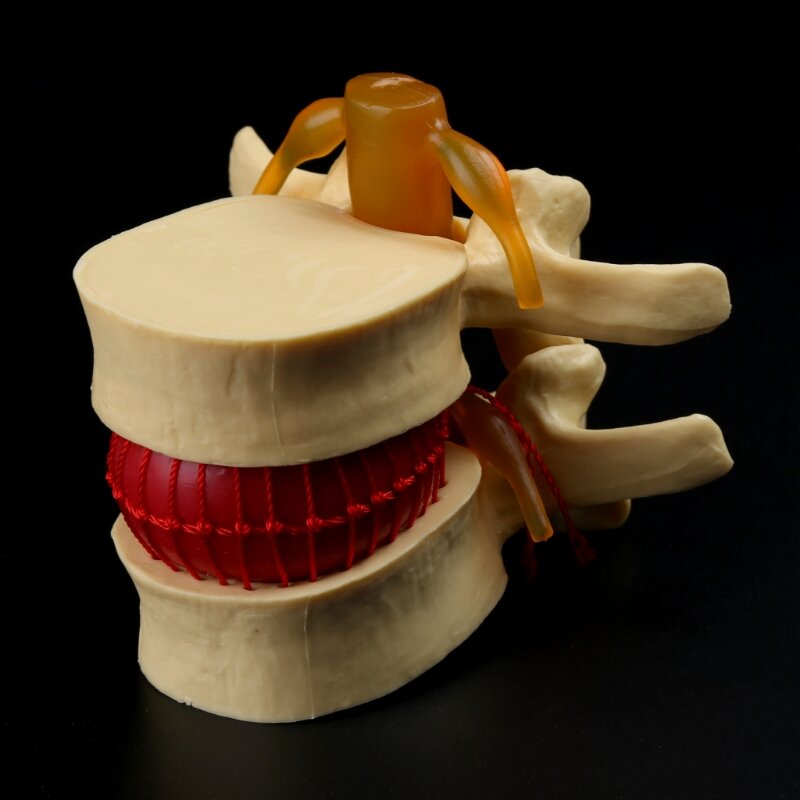 Outil d'enseignement médical d'anatomie de hernie discale lombaire de colonne vertébrale anatomique
