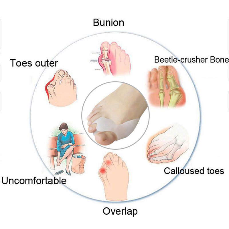 1 par de silicone toe separador sobreposição reabilitação tratamento hallux valgus aparelho aparelho orthotic pés palmilhas cuidados