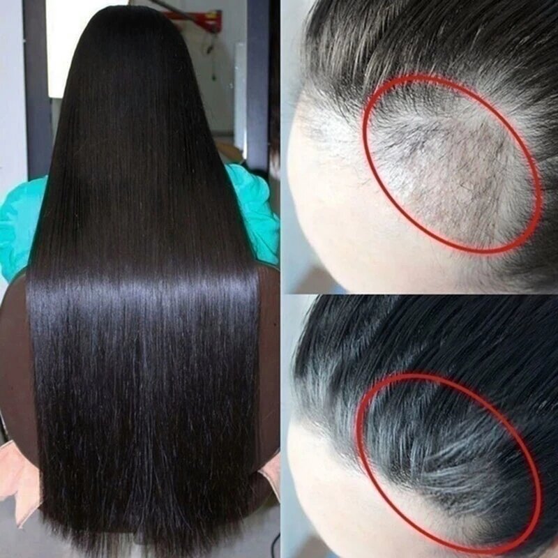 Engrossador de crescimento capilar, óleos essenciais para tratamento de perda, antiperda, adequado para todos os tipos de cabelo