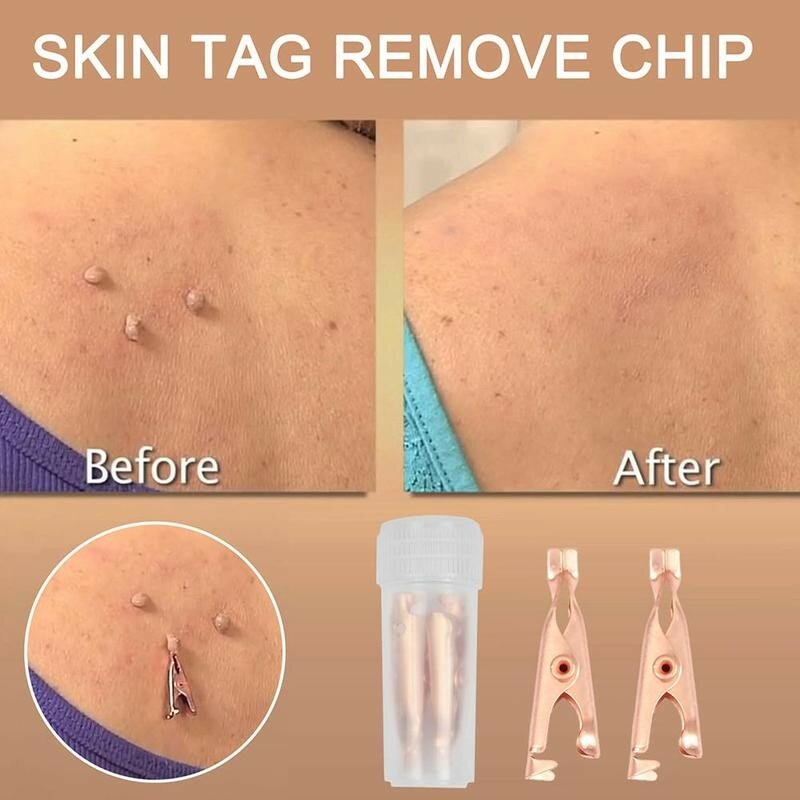 Skin Tags Remover 1/2/6/12pcs Copper Pointed Mouth Wart Removal Clip Pointed Mouth No Teeth Flat Mouth Clip Wart Removal Clip