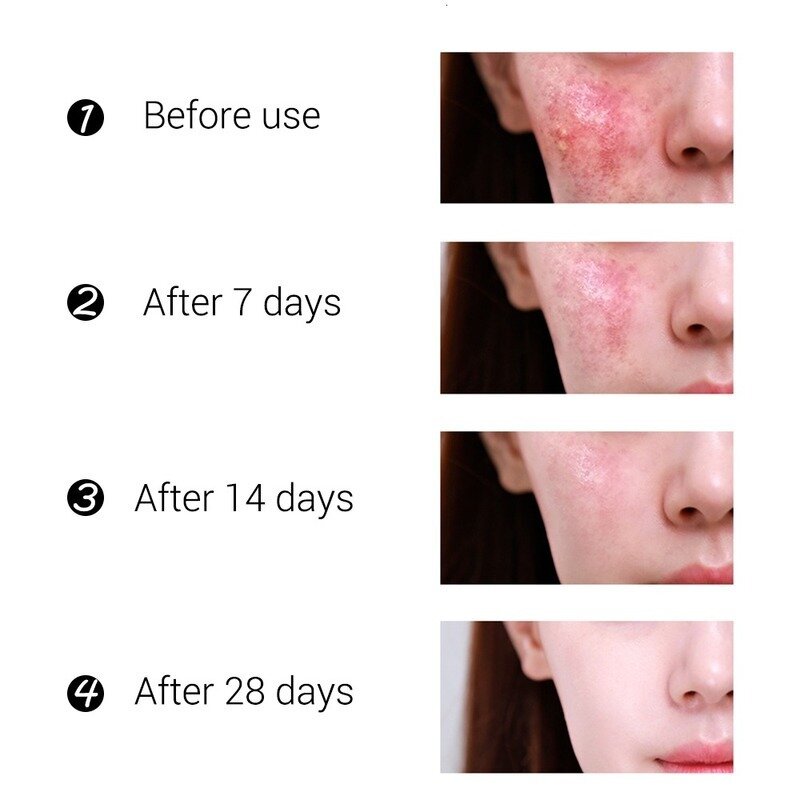 Anti-Ance Entfernung Creme Akne Behandlung Verblassen Akne Flecken Öl Control Schrumpfen Poren Bleaching Feuchtigkeits Akne Creme Hautpflege