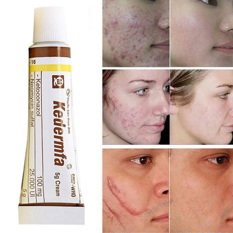 Crème professionnelle à l'huile de serpent du Vietnam, 5g, pour enlever les cicatrices, traitement de l'acné, soins du visage et de la peau, naturelle, TSLM1