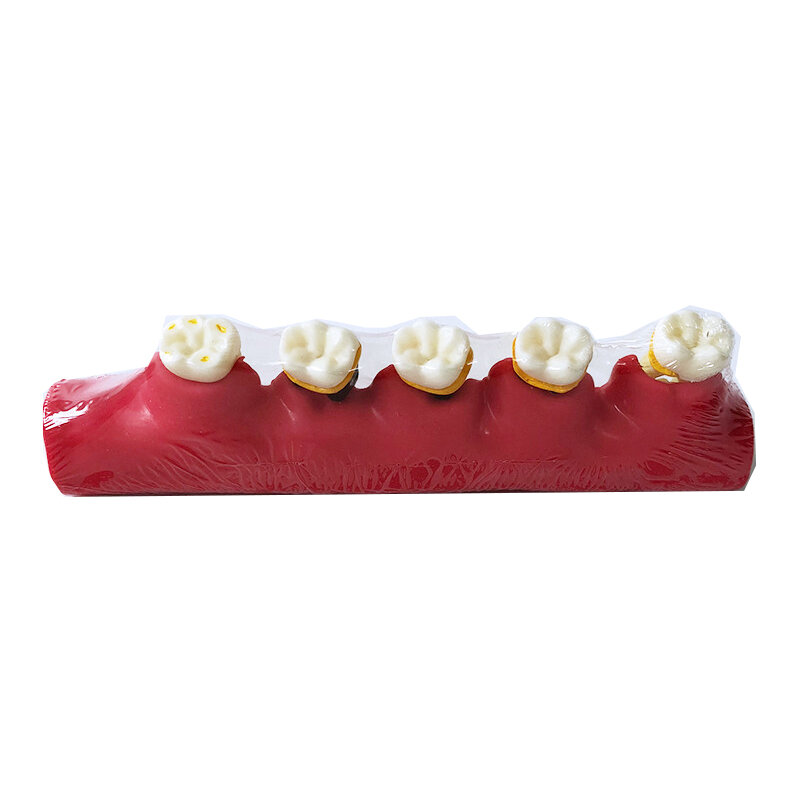 مرض اللثة نموذج لشكل الأسنان/نموذج مرض الأسنان M4010 نموذج تسوس يوضح تقدم أمراض اللثة