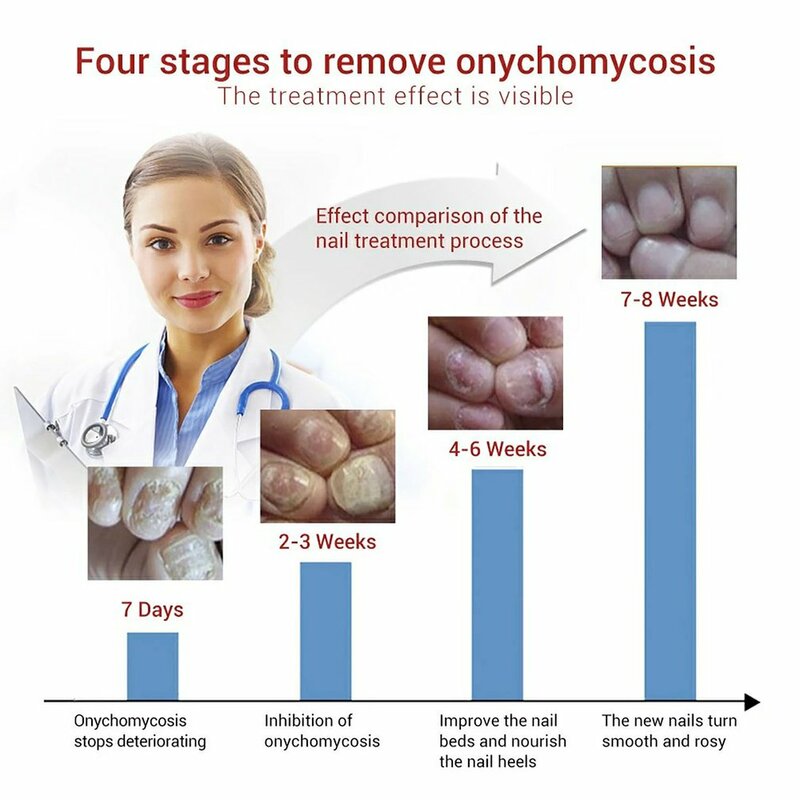 เล็บเชื้อรา Treatment Feet Care Essence ฟอกสีฟันเล็บเท้ากำจัดเจล Anti Infection Paronychia Onychomycosis