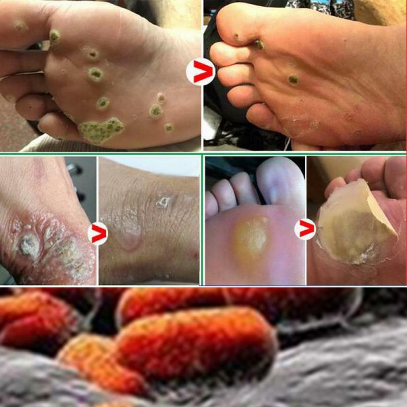 Removedor de marcas na pele, removedor de marcas na pele, tratamento para cuidados com os pés, removedor de cravos no líquido tslm1 com 10ml