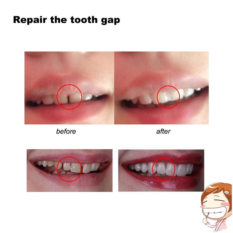 Material de llenado temporal de dientes, herramienta Dental de reparación, higiene bucal, blanqueamiento de dientes, TSLM1