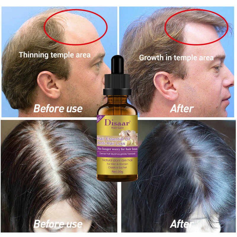 30ML Natural Organic Hair Essential Oil Anti-Hair Loss Accelerate Hair Growth Serum Nourish Scalp Hair Safe Healthy Treatment