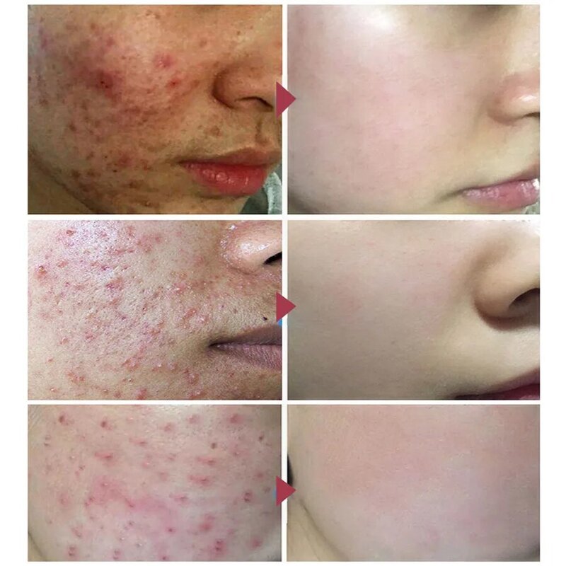 MeiYanQiong-suero facial para tratamiento del acné, esencia blanqueadora, hidratante, Control de aceite Centella asiática, reduce los poros y las cicatrices