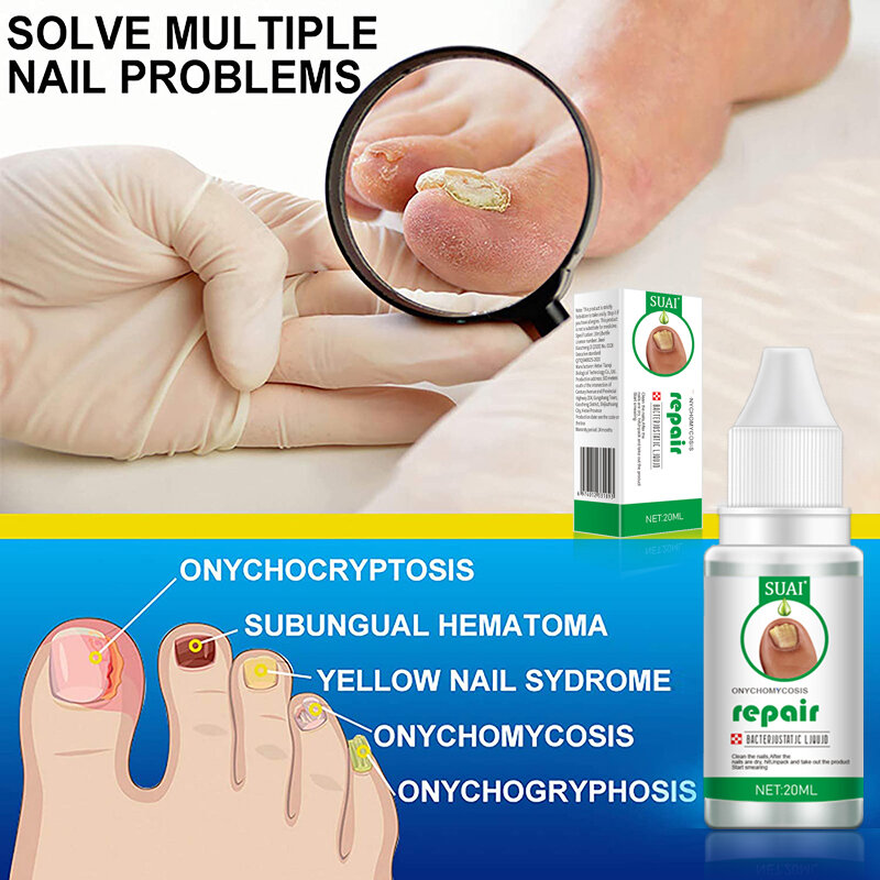 20ML leczenie grzybicze paznokci pielęgnacja stóp preparat do paznokci stóp usuwanie grzybicy paznokci żel leczenie infekcji Paronychia Onychomycosis