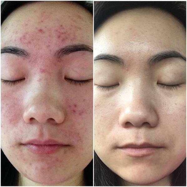 Crema originale ACNELYSE 0.025 Retinoic vitamina A ATRA EXP:2022 trattamento dell'acne rughe sottili macchie scure pelli ruvide danni al sole
