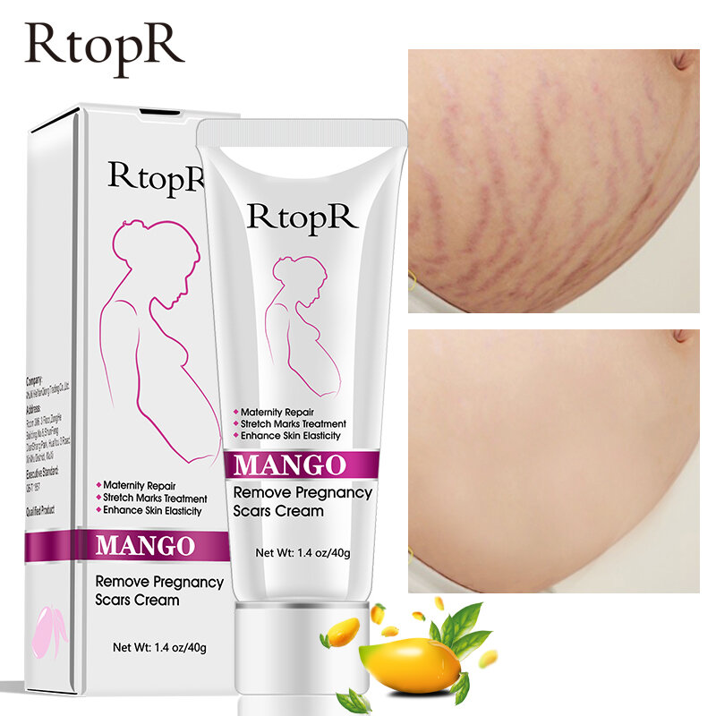 Mango ลบการตั้งครรภ์รอยแผลเป็นครีม Stretch Marks Treatment สำหรับคลอดบุตร Skin Repair Anti-Aging Anti Winkles Firming Body ครีม