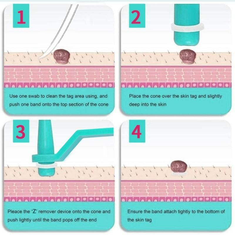 1 Set Huid Tag Verwijderen Kit Thuisgebruik Mol Wratten Remover Apparatuur Micro Huid Tag Behandeling Tool Gemakkelijk Te Reinigen skin Care Tool