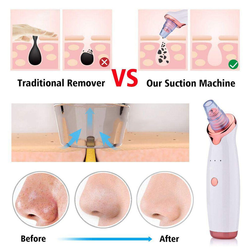 Removedor de cravo facial, limpador de poros profundo, extrator de acne preto, máquina elétrica de cuidados com a pele a vácuo de cravo microcristalino