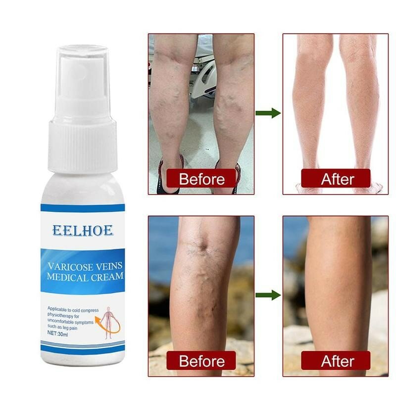 Solução natural varicosa veia calmante spray veias tratamento spray em perna ácido bilges prurido caroços de minhoca cura perna ruim