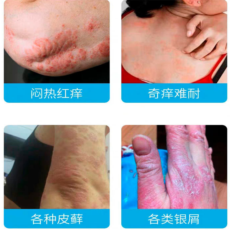 Skin care herbal antibacterial ointment wet itchy ointment adult skin itching ointment