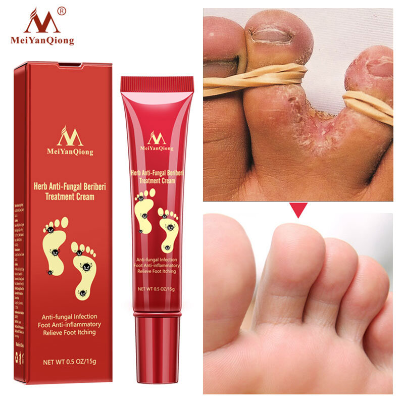 Herbal Effective Foot Cream Treatment Anti Fungal Infection Onychomycosis Paronychia Toe Fungus Gel Repair Dry Crack Feet Care