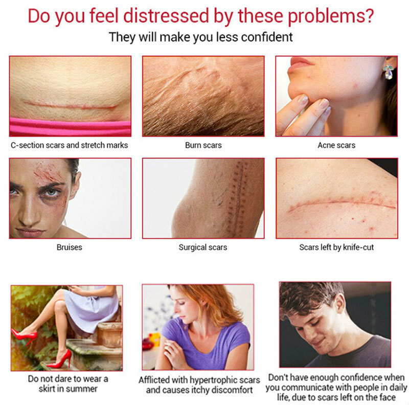 Efficace rimozione della cicatrice dell'acne crema trattamento Acne smagliature brufoli macchie riparazione Gel sbiancante levigante cura della pelle del corpo 30g