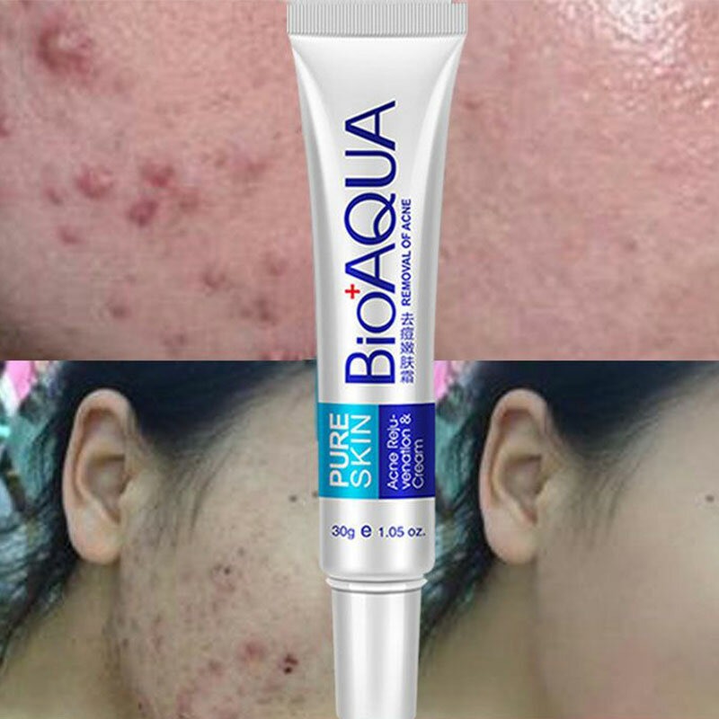 Bioaqua acne cicatriz remoção creme gel anti-acne tratamento rosto clareamento creme controle de óleo desvanece-se ponto escuro poros minimizador cuidados com a pele