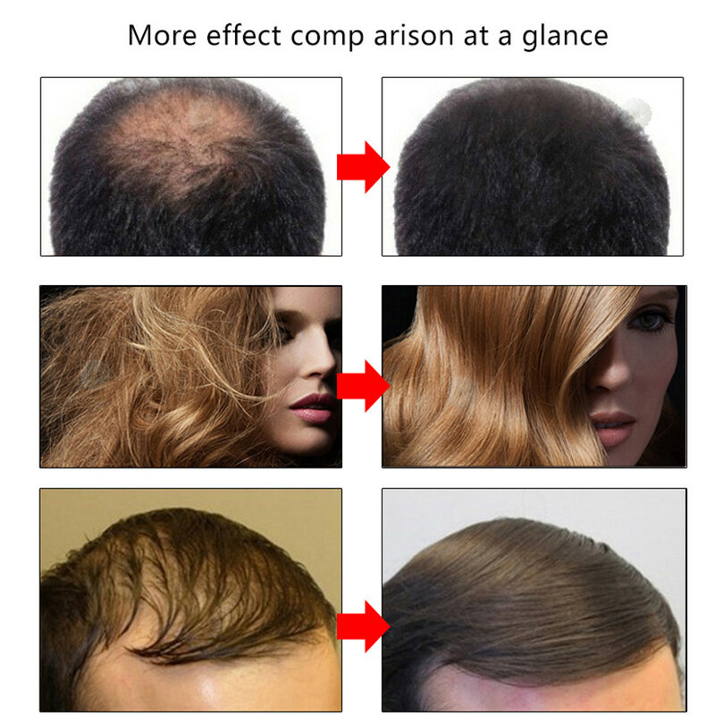 20 مللي منتجات نمو الشعر منع تساقط الشعر النفط سريع إعادة نمو الشعر جوهر استعادة جذور الشعر شعري كثيفة العناية بالشعر رجل امرأة