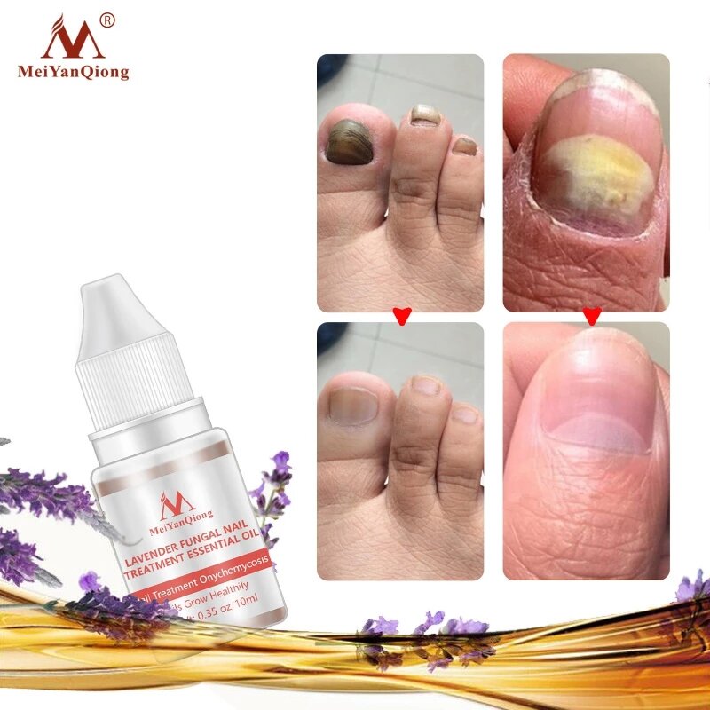 MeiYanQiong FungalNail Treatment Serum Lavenda Onychomycosis Paronychia Anti-Fungal Nail Infection Herbal Toe Fungus Foot Repair