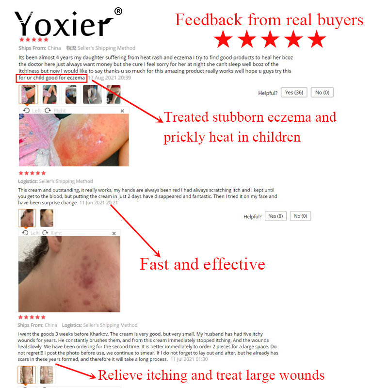 Yoxier สมุนไพร Antibacterial Cream โรคสะเก็ดเงินครีม Anti-Itch Relief กลากผื่นโรคลมพิษ Desquamation 20G