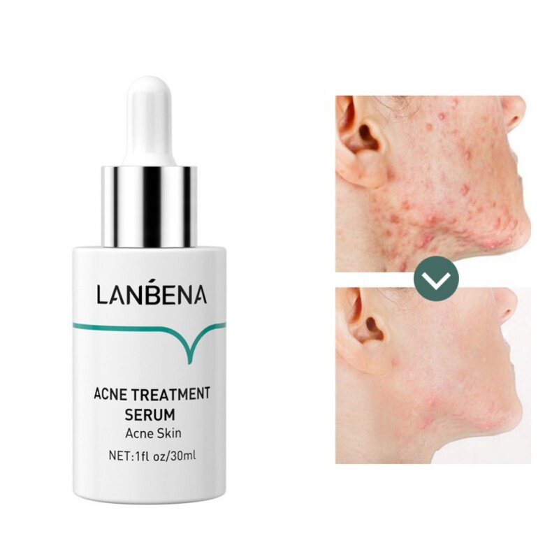 Soro da acne da pele da acne do tratamento da acne limpeza profunda remova a graxa crônica completamente