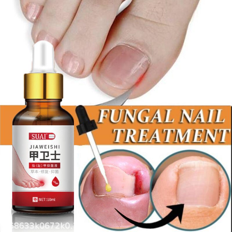 Traitement antifongique pour les ongles, essence, Anti-Infection, réparation fongique des orteils, sérum dissolvant, soins des mains et des pieds