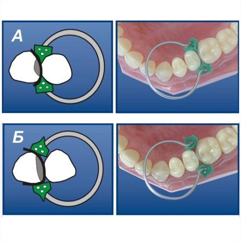 Набор секционных контурных матриц AZDENT Dental Matrix + 40 силиконовых дополнительных клиньев + стоматологические плоскогубцы