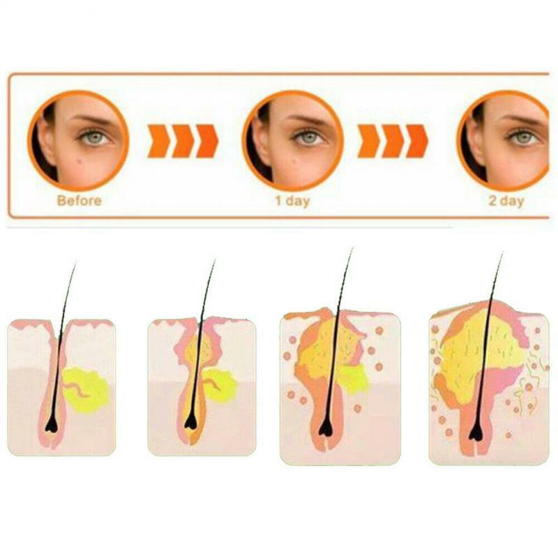 36Pcs/Sheet Acne Pimple Patch Invisible Acne Stickers Blemish Treatment Acne Master Pimple Remover Tool Skin Care