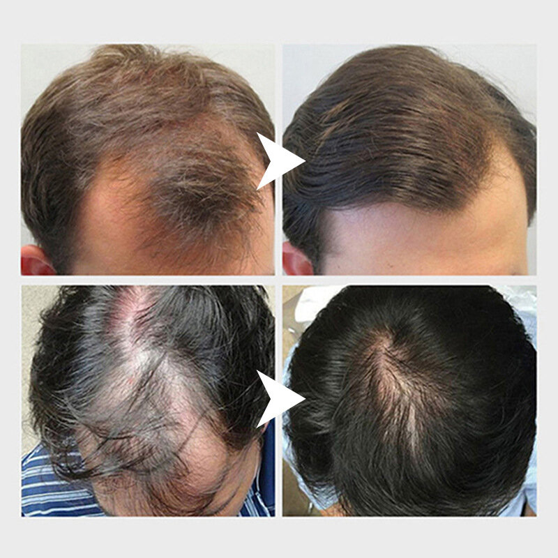 Arroz água produtos de cabelo crescimento do cabelo homem mulher promover o crescimento do cabelo rápido reparação danificado nutrir raízes do cabelo anti queda de cabelo